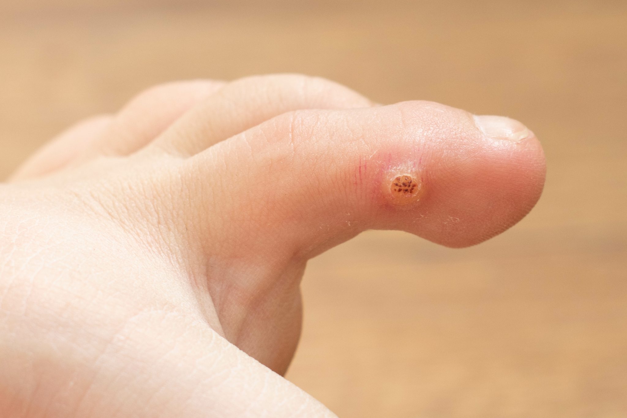 Warts On Your Feet Symptoms Causes Of Plantar Warts Foot And Ankle