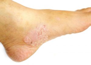 4 Common Foot Skin Problems & Treatments - Foot and Ankle Group