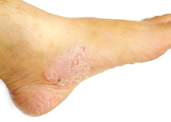 4-common-foot-skin-problems-treatments-foot-and-ankle-group