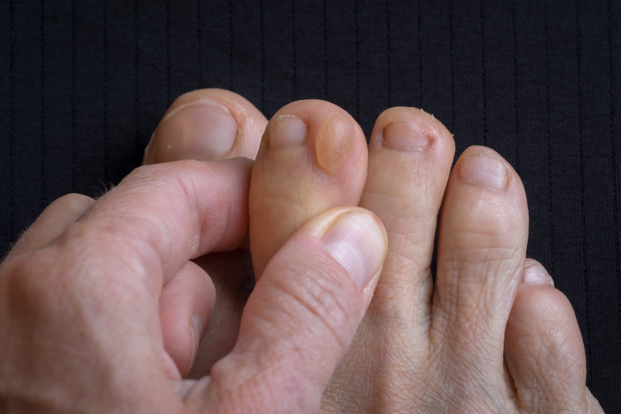 what-s-the-difference-between-foot-corns-vs-foot-calluses-foot-and