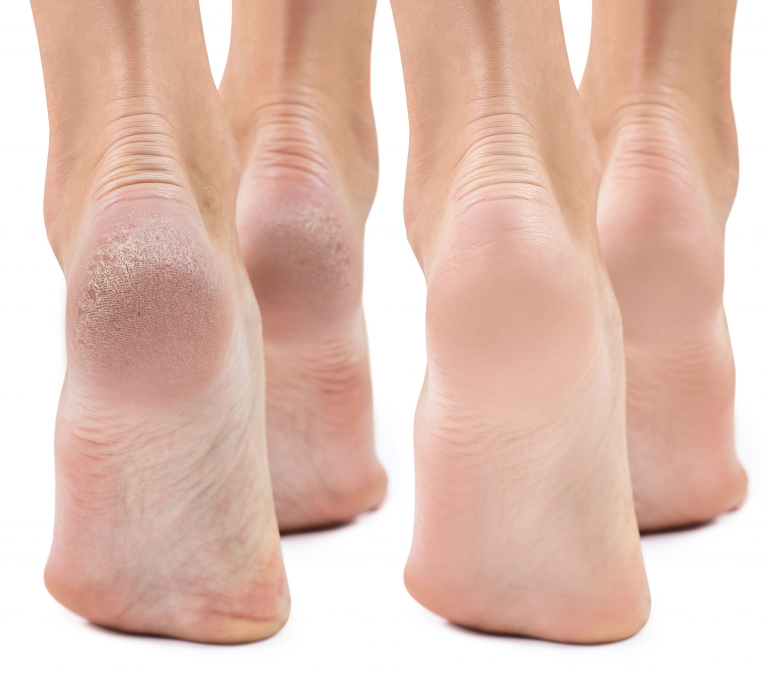 Dry Feet Cracked Heels Causes Treatment 1536x1360 