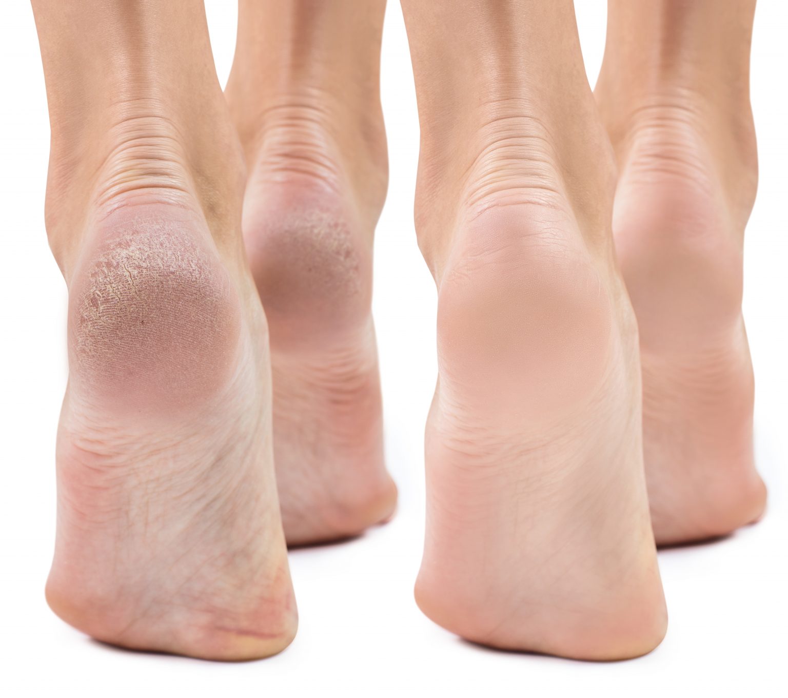 Dry Feet Cracked Heels Causes Treatment Foot And Ankle Group