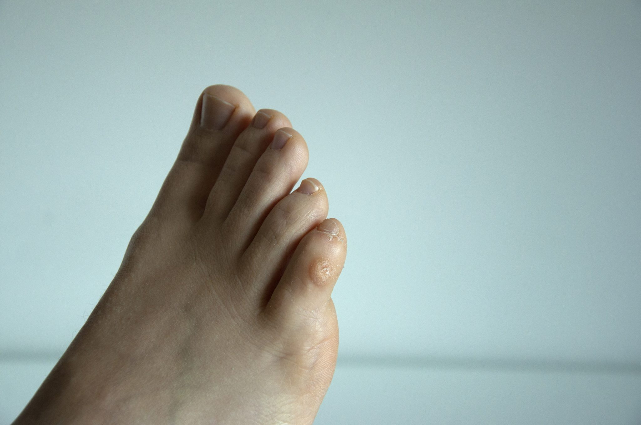 What’s the Difference Between Foot Corns vs Foot Calluses? Foot and