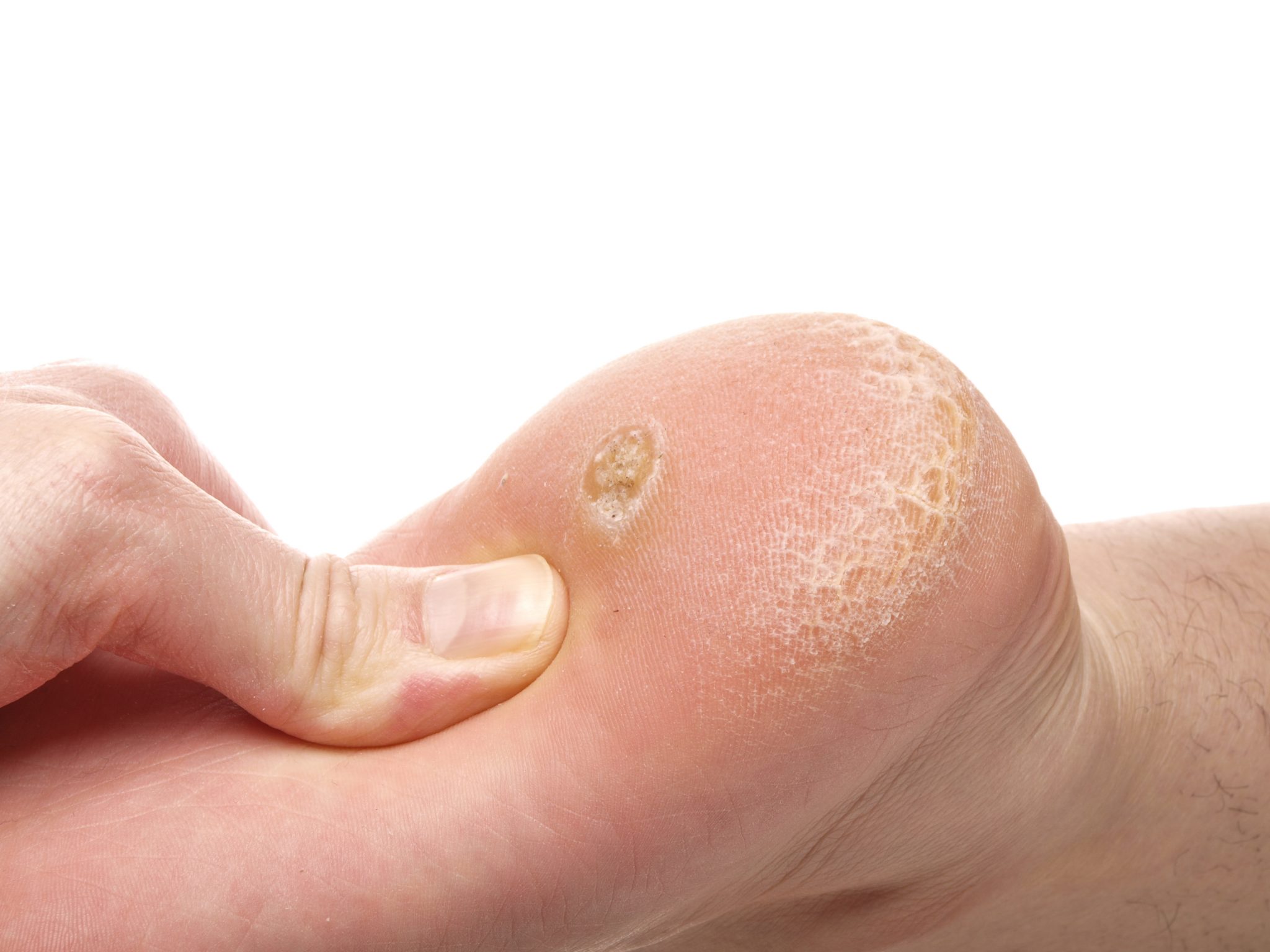 What’s the Difference Between Foot Corns vs Foot Calluses? Foot and