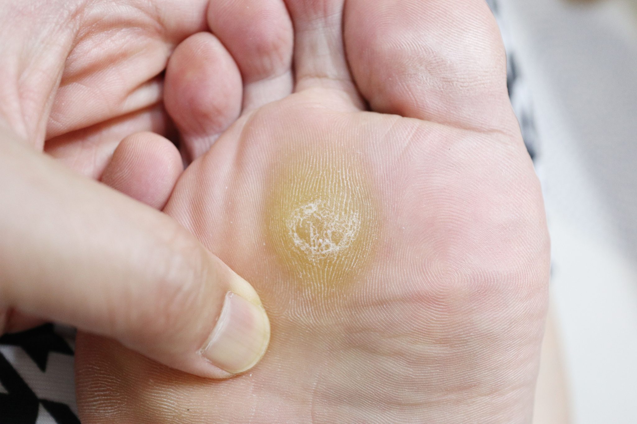 When is it a Callus and When is it a Wart?: Podiatry Hotline Foot