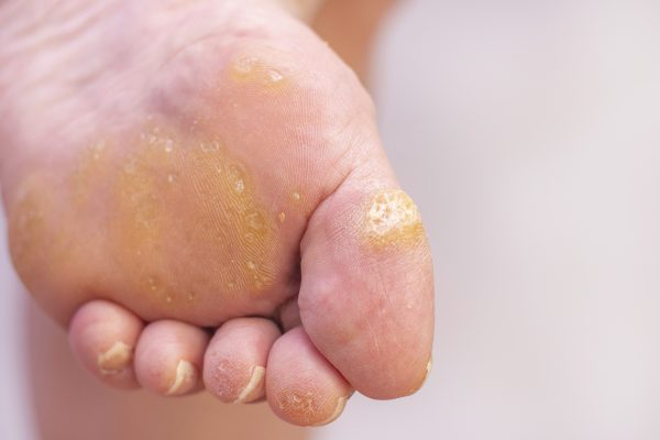 pulling out plantar wart root