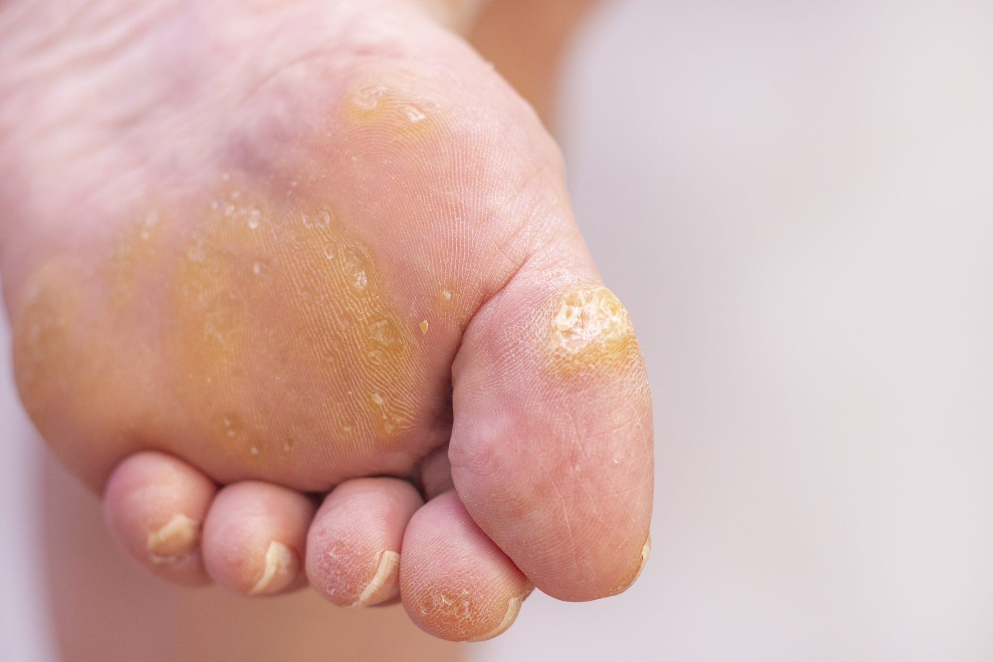 Calluses On Hands And Feet: Simple Home Remedies To Get Rid Of Ugly Corns