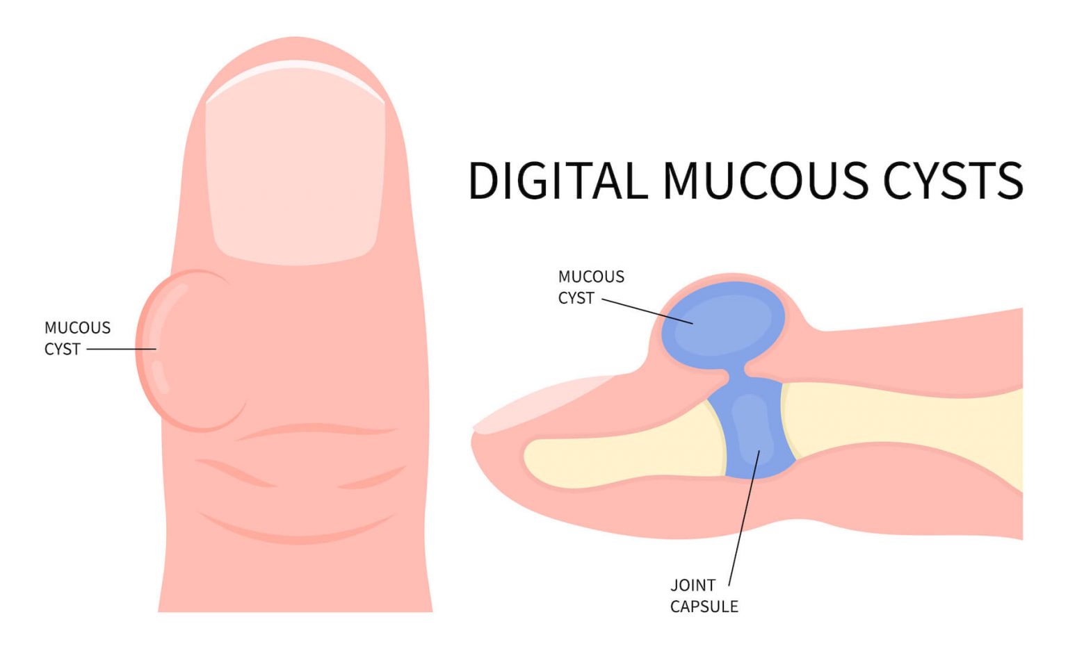 How To Treat A Digital Mucous Cyst On Your Toe Foot And Ankle Group