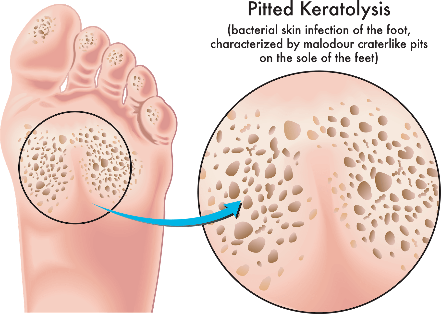 Understanding Pitted Keratolysis Causes, Symptoms, and Diagnosis Foot and Ankle Group